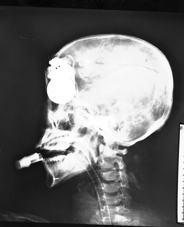 From the Cracked article,"...Vietnam was a terrible goddamn thing. This hapless soldier found himself in this predicament after he stepped on a landmine, which, by itself, is pretty darn unlucky. When the grenade he was carrying on his chest was blown inside of his own head by the other, unrelated explosion going off right beneath his feet, he officially entered wrathful god/gypsy curse territory."