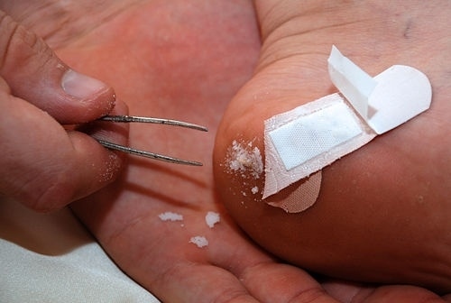 The baking soda paste will cause the skin to swell and push the splinter out. Get more info here.