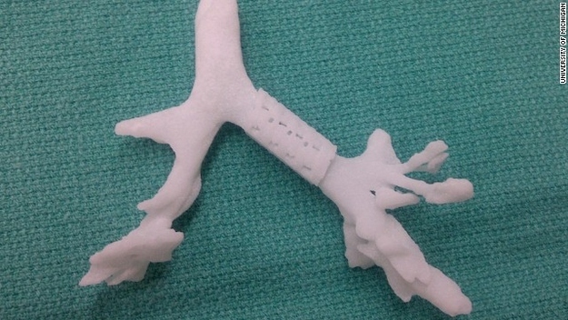 Polycaprolactone (PCL), the material used for this splint, is also used for filling in areas left open from skull surgery.
