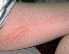 When I first saw stretch marks on my inner thighs, I thought I had a flesh-eating disease. I made the mistake of Web MD-ing but it turns out this is a regular thing all humans have.