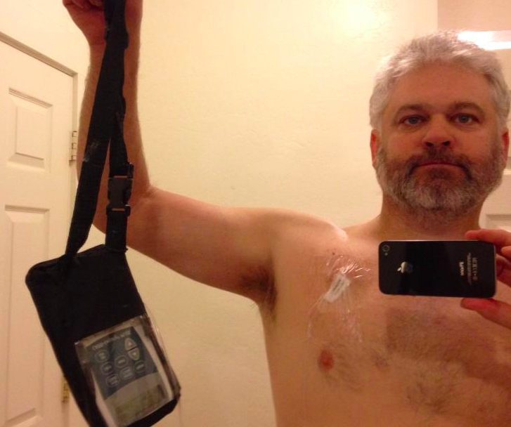 Fahey with his chemo pump.