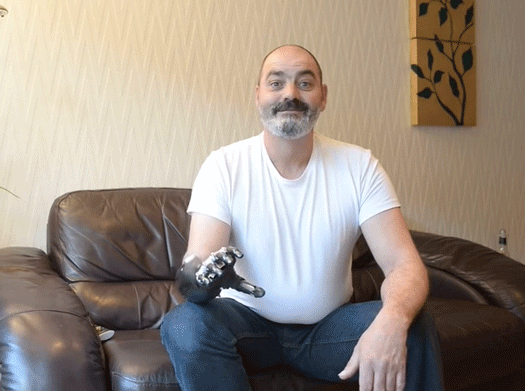 Controlled by just two muscles in his amputated arm, this prosthetic is able to perform a huge variety of "finger" positions.