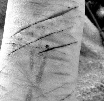 Self Harm: Is It Easy To Stop? - Mibba