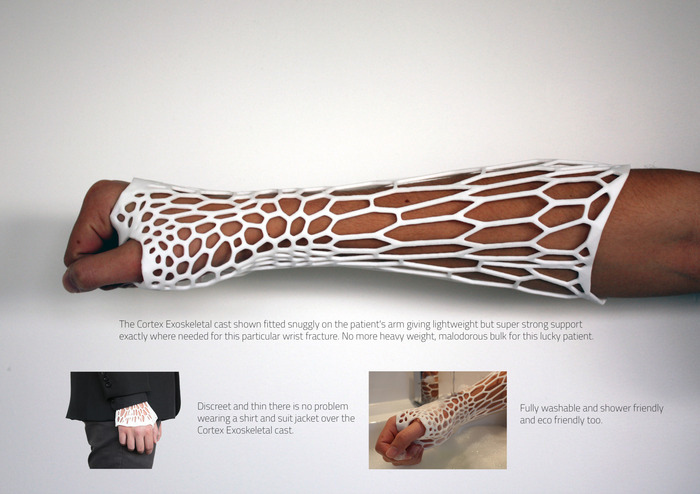 The prototype Cortex cast is “lightweight, ventilated, washable and thin enough to fit under a shirt sleeve.” Say goodbye to itchy and smelly casts.