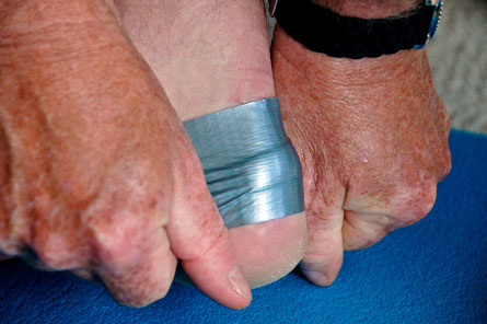Use the duct tape to deal with blisters.