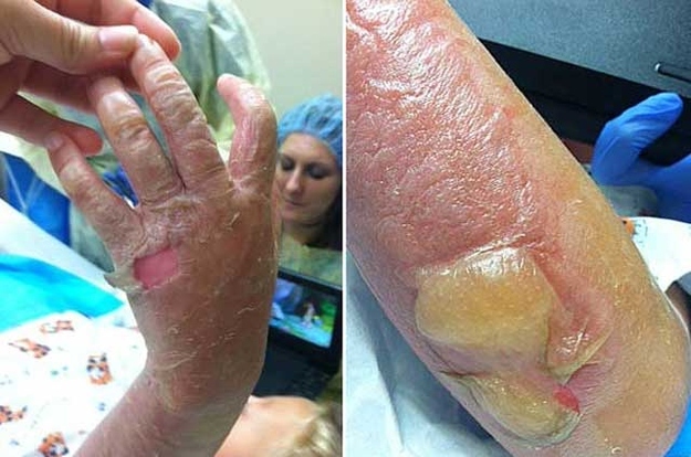 Ellwanger later remembered that they'd played with limes from a neighbour's tree, squeezing the fruits and splashing in the juice. They were diagnosed with phytophotodermatitis, a chemical reaction to citrus juice that makes bare skin hypersensitive to ultraviolet light.