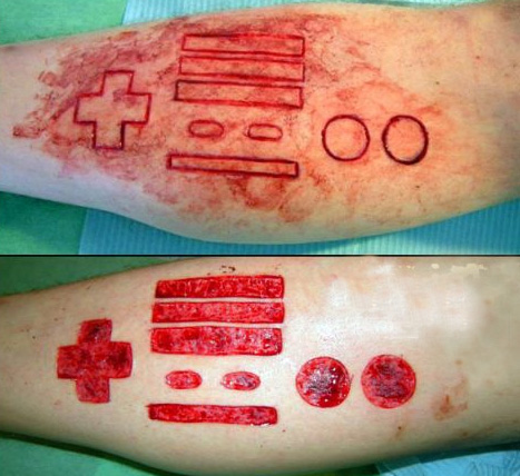 Some poor bro carved a classic Nintendo controller into his forearm and then proceeded to peel the skin off from inside the shapes. Wowzers.