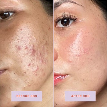 before and afters showing a model with acne scarring, and then a photo of their skin looking much more clear