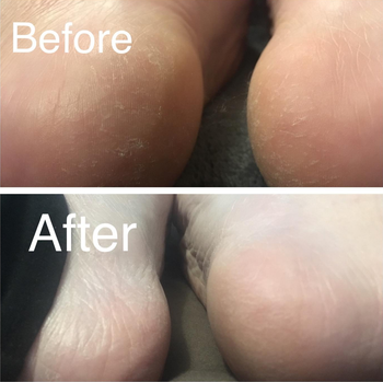 reviewer with rough heels before and smoother heels after