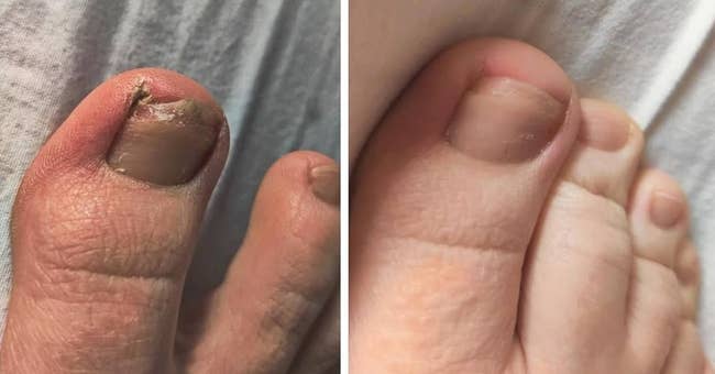 top: reviewer photo after using the renewal treatment with toenail fungus gone / bottom: reviewer before photo of a fungal toenail