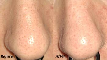 Close-up of reviewers nose showing pores before and after treatment