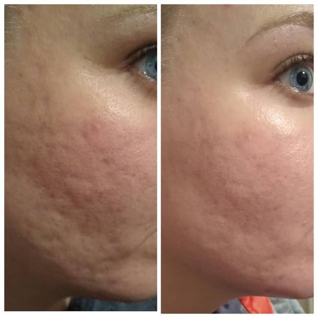 before image of reviewer with acne scarring and after image of the same reviewer with noticeably smoother skin