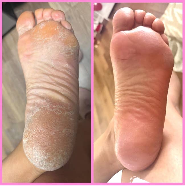 Before and aft  images showing a ft  with dry, cracked tegument  and the aforesaid  ft  aboriginal    looking creaseless  and restored