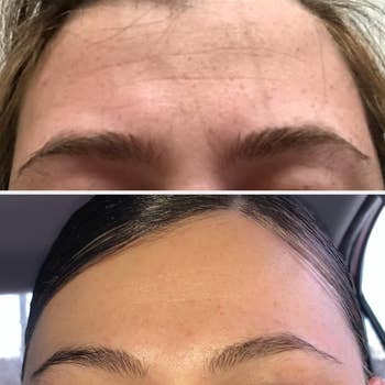 Before and after comparison of a person's forehead, with the after showing reduced appearance of wrinkles