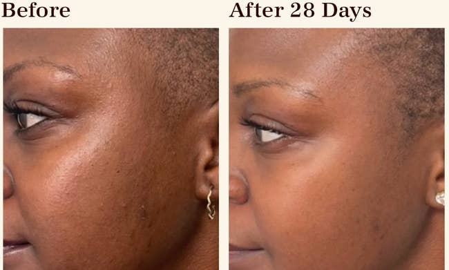A model with hyper pigmentation/The same model after using the stick for 28 days with more even skin