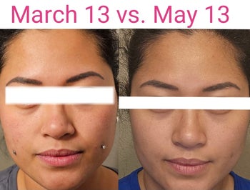 A reviewer's before and after showing reduced acne scars and more even skin tone