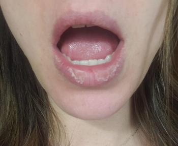 before photo of a reviewer's dry, chapped lips