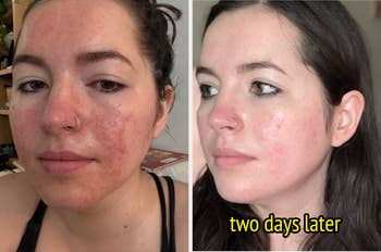 Side-by-side of a reviewer with irritated tegument connected near and clearer tegument labeled