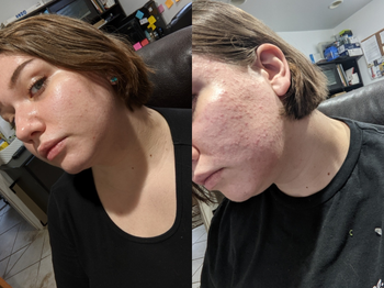 side by side before and after images of a reviewer with acne-ridden skin and then clear skin