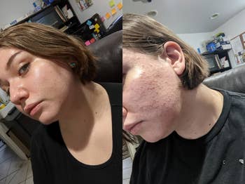 side by side before and after images of a reviewer with acne-ridden skin and then clear skin