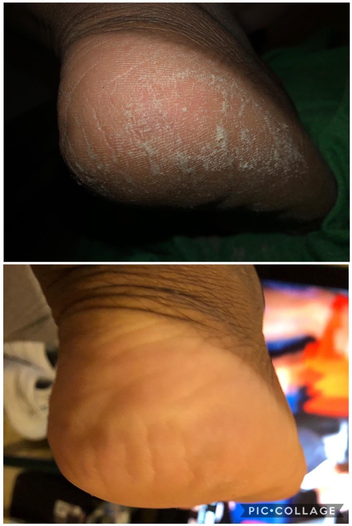 on top: heel covered in dry skin. on bottom: same heel without cracking and dry spots after using callus remover gel