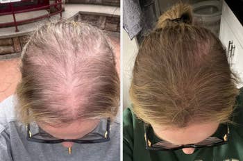 Side-by-side examination of a person's scalp showing hairsbreadth thinning connected the near and improved hairsbreadth density connected the right