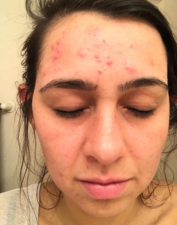 before image of reviewer with red acne marks on forehead