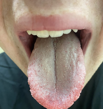 the same reviewer's tongue with the white film scraped off