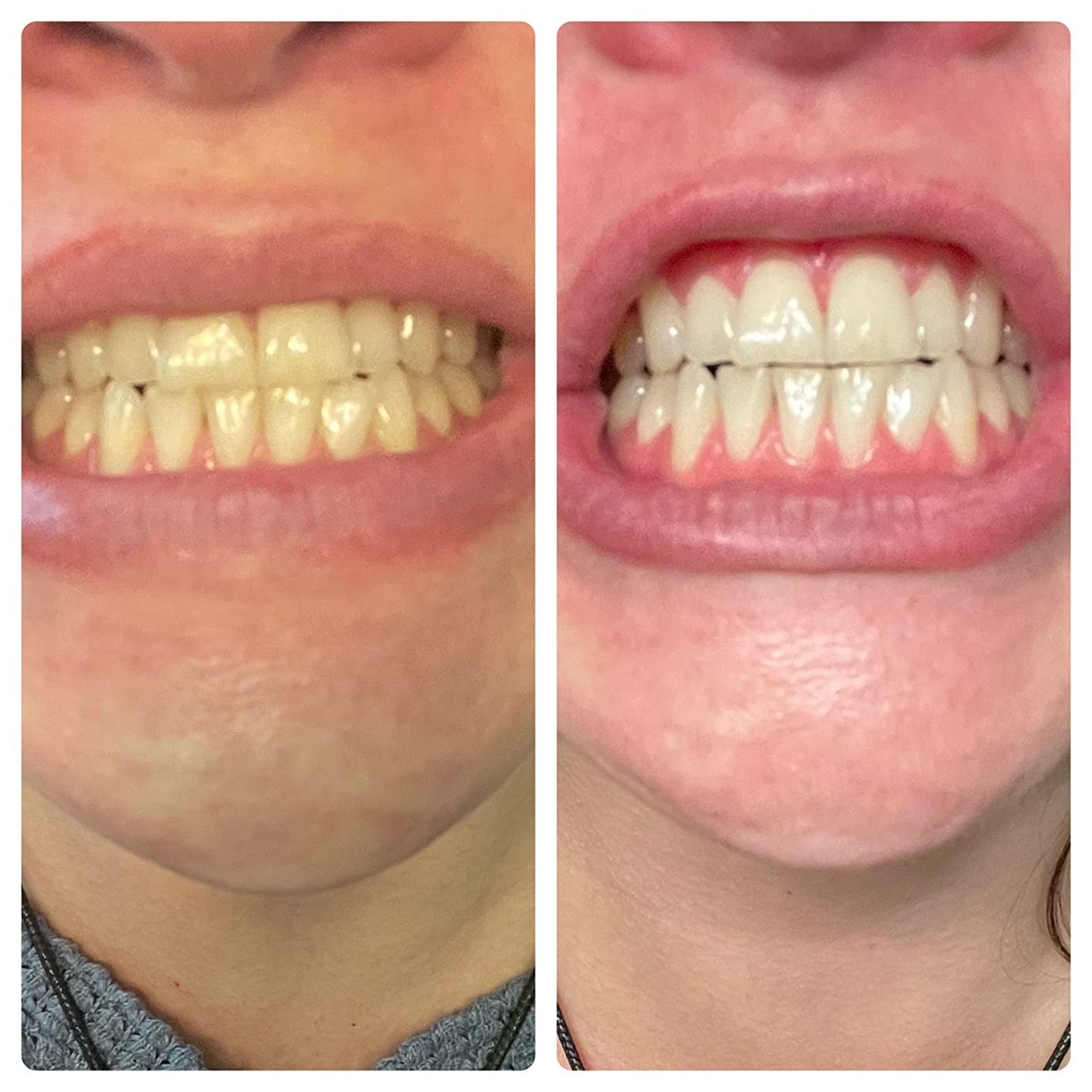 side by side before and after images of a reviewer whose yellow teeth become whiter