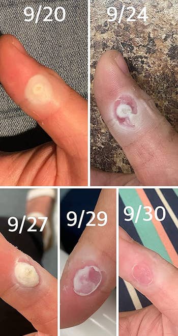 reviewer photo series showing the progression of a pad removing a wart from their finger over 10 days