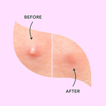 A pimple before using the patch/pimple after using the patch with a noticeable improvement 