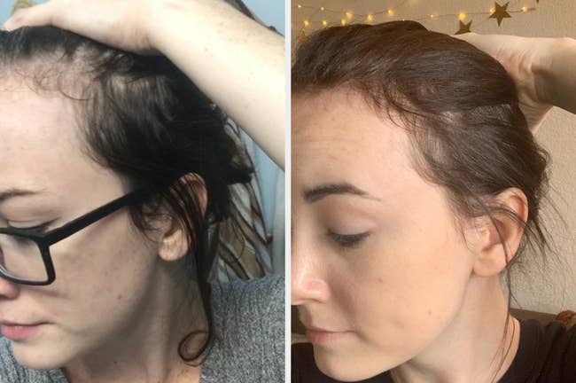 Two side-by-side images showing a person's hair growth progress over time