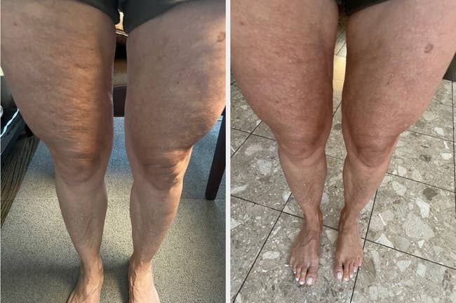 reviewer's before/after showing the skin on their legs looking smoother and tighter