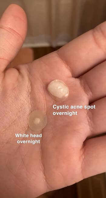 Reviewer holding two used pimple patches: one on a white head and the other on cystic acne