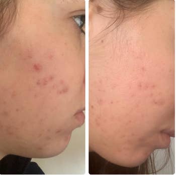 Reviewer before and after with redder acne in before picture and faded in the second 