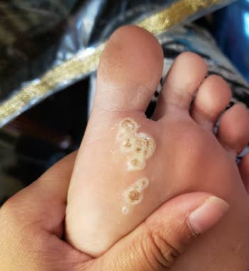 reviewer with several warts on the bottom of their foot 