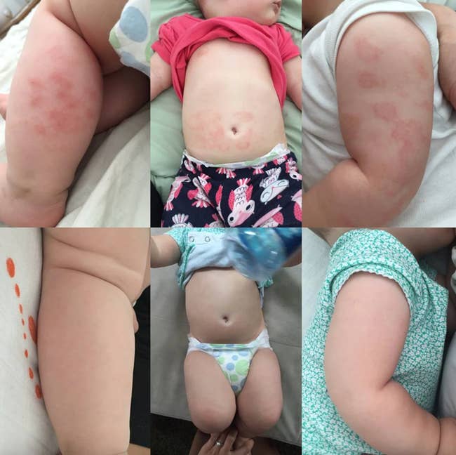 six side by side before and after images of eczema on a baby's leg, stomach, and arm being cleared up