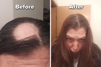 reviewer before and after of a bald spot on their head and their hair grown out