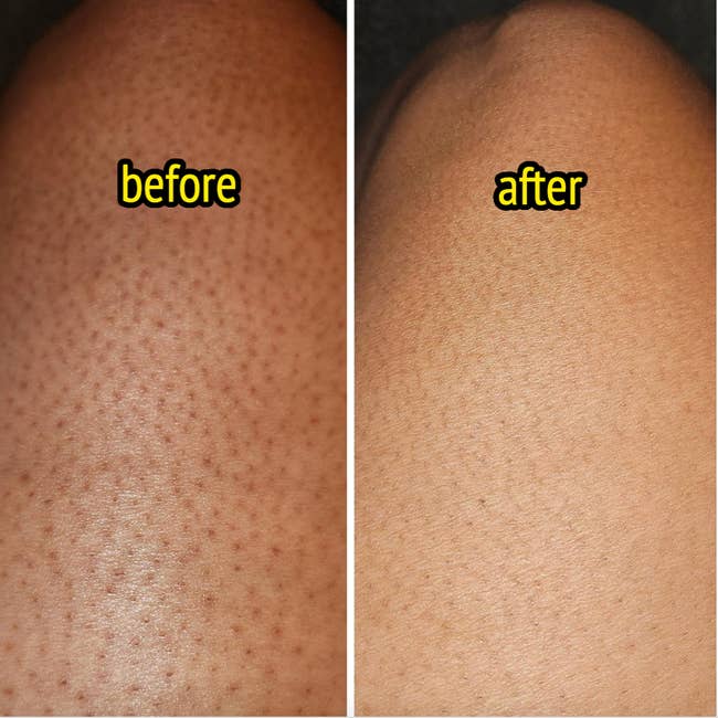 Side-by-side examination  of tegument  texture earlier  and aft  utilizing a product, showing smoother tegument  successful  the 