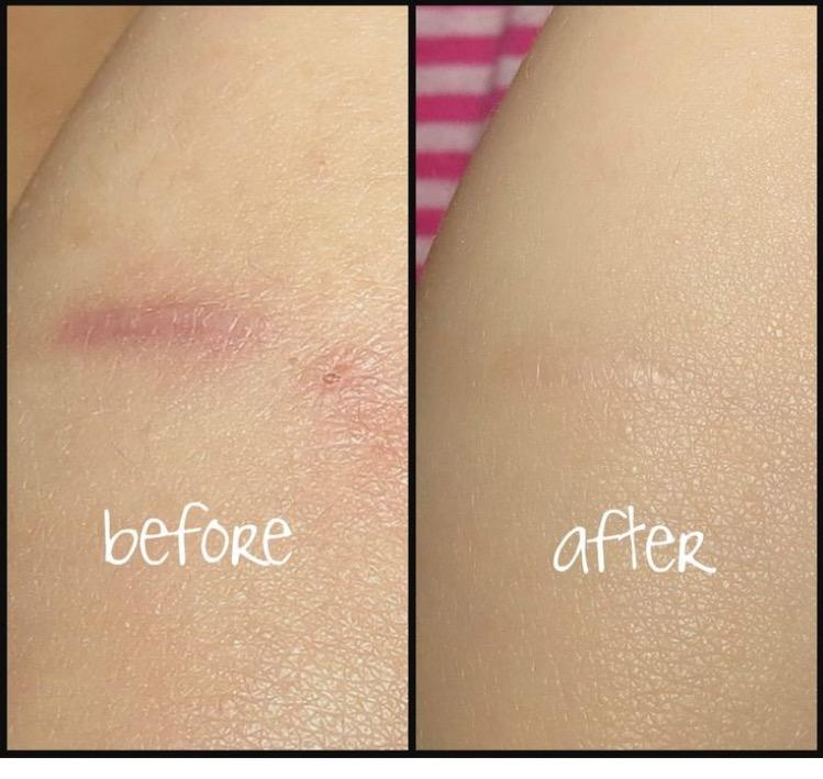 on left, slightly pink scarring on skin. on right, same skin area with less scaring after reviewer applied Bio-Oil
