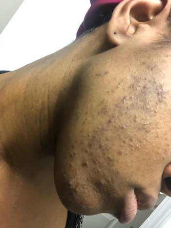 a reviewer photo of their skin with acne