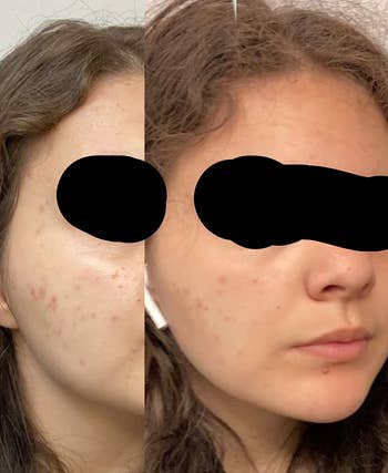 A reviewer showing a before and after photo of using this product on their skin