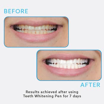a before and after photo showing how the models teeth are far whiter after 7 days of use