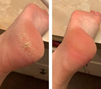 reviewer before and after showing their heel looking rough and cracked on the left, and their heel looking smooth after using the foot cream on the right