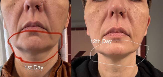 Comparison of 2 images showing a woman's chin country connected the 1st time and 12th day, highlighting changes successful tegument texture