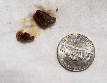 reviewer image of two clumps of earwax next to a nickel for size comparison