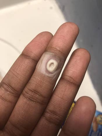 reviewer's finger with a a wart on it