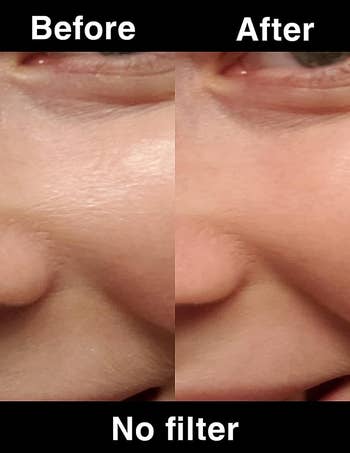 before/after of a face that was oily and looks matte after using the roller