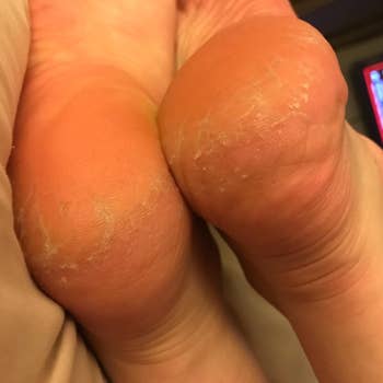 The reviewer's heels rid of calluses after using the pumice stone