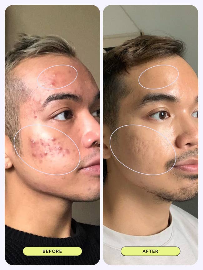 model skin before and after using cleanser with acne improved after
